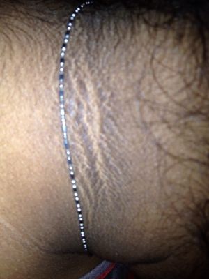 Acanthosis-nigricans.jpeg