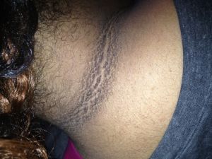 Acanthosis-nigricans-2.jpeg